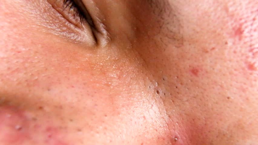 Blackhead Squeezer