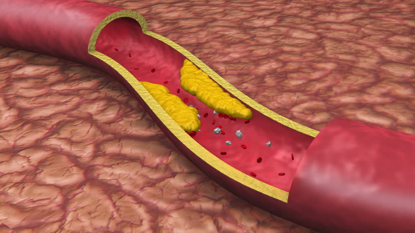 Clogged Artery Low Angle Digital Animation With Platelets And
