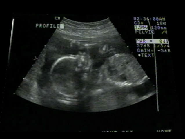 High Quality Ultrasound Echography Check Gynecological Medical Examination 33 Weeks Old