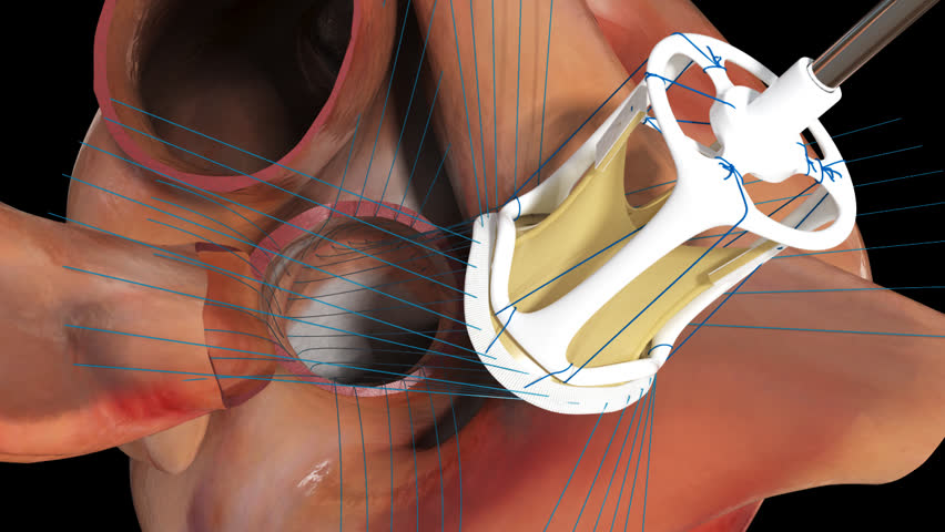 3d Animation Of Aortic Valve Replacement Surgery Showing Insertion Of