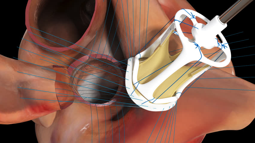 Is Aortic Valve Replacement Surgery Dangerous