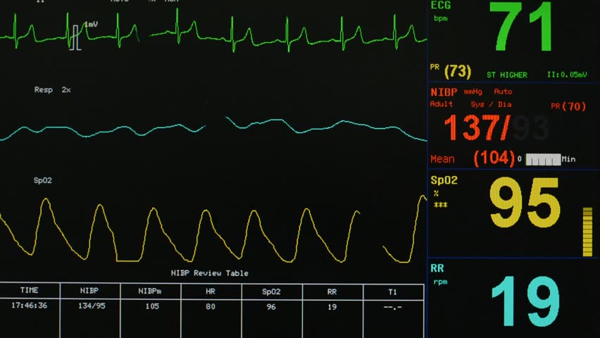 Hospital ICU Station Monitor Displays Patient Vital Signs, ECG, SP02 ...